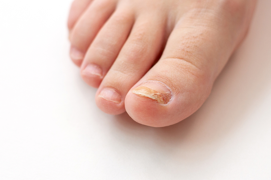 White Superficial Onychomycosis Causes